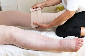 lymphoedema therapy